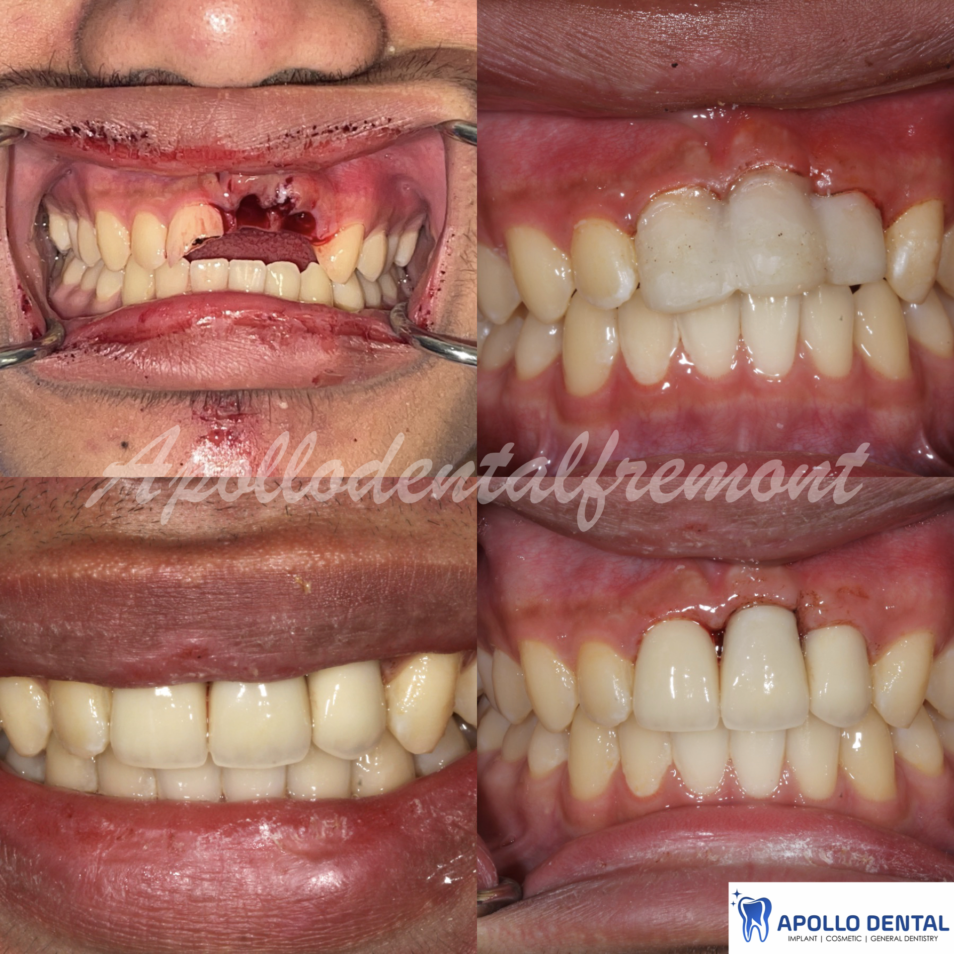 15 y_o Patient lost his teeth skating, saved the teeth. Has his original teeth in the mouth