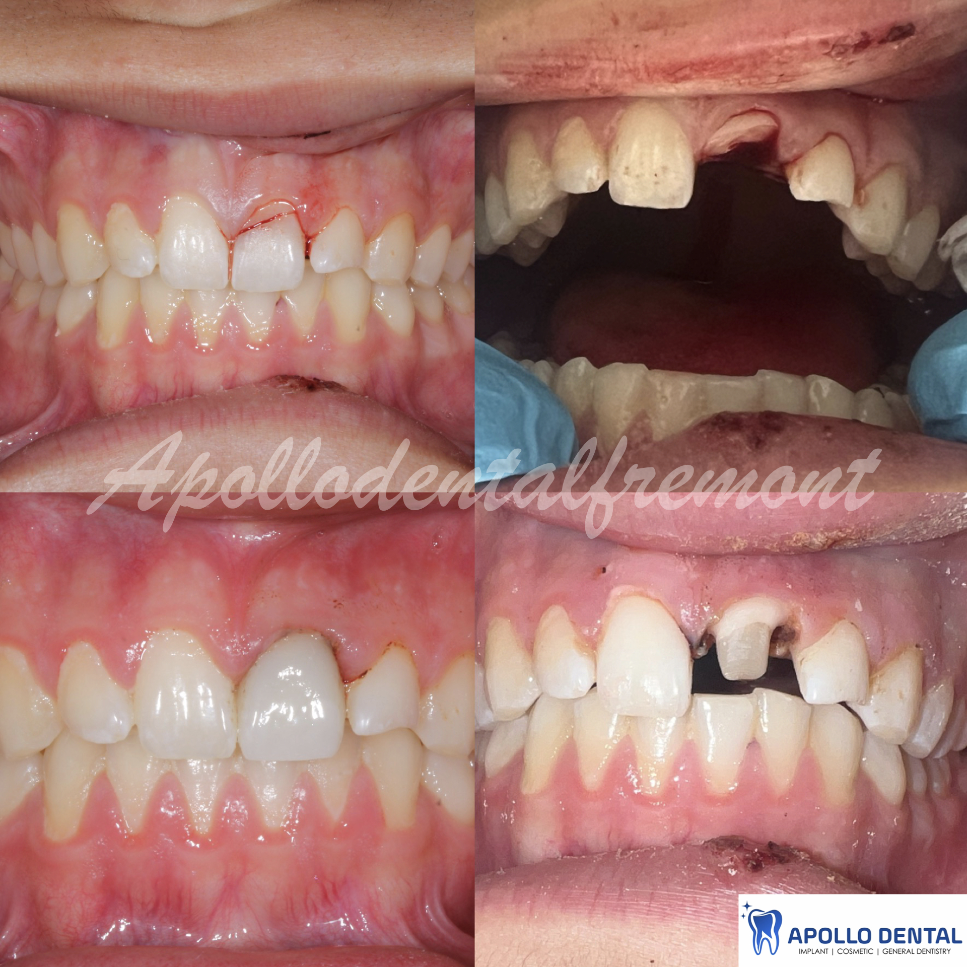 16 y_o old patient broke tooth playing baseball. saved the tooth until something else can be used to restore the tooth in the future.