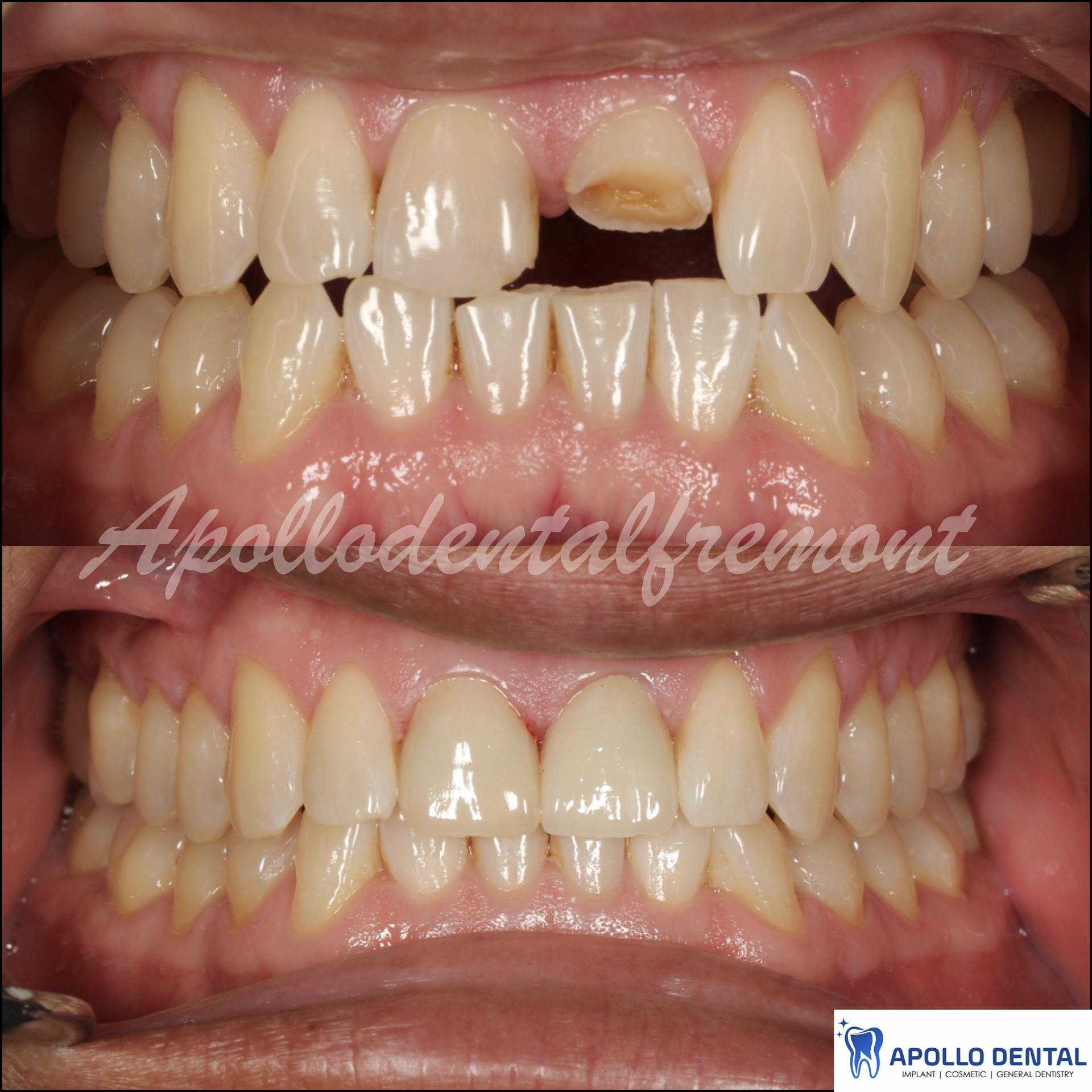 Broken tooth fixed with crown and veneer