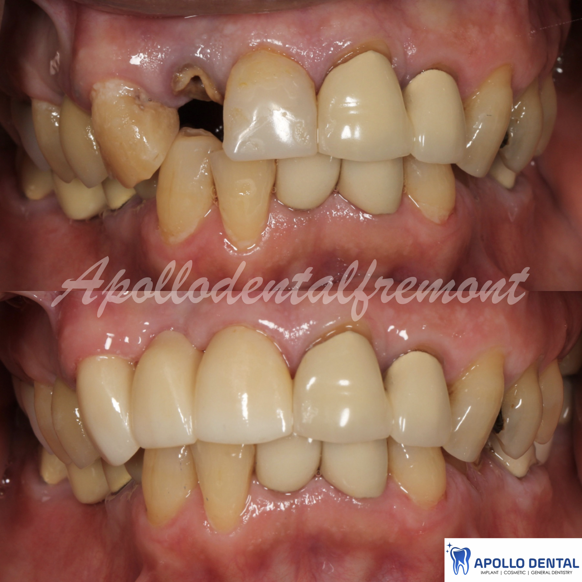 Broken tooth fixed with dental bridge