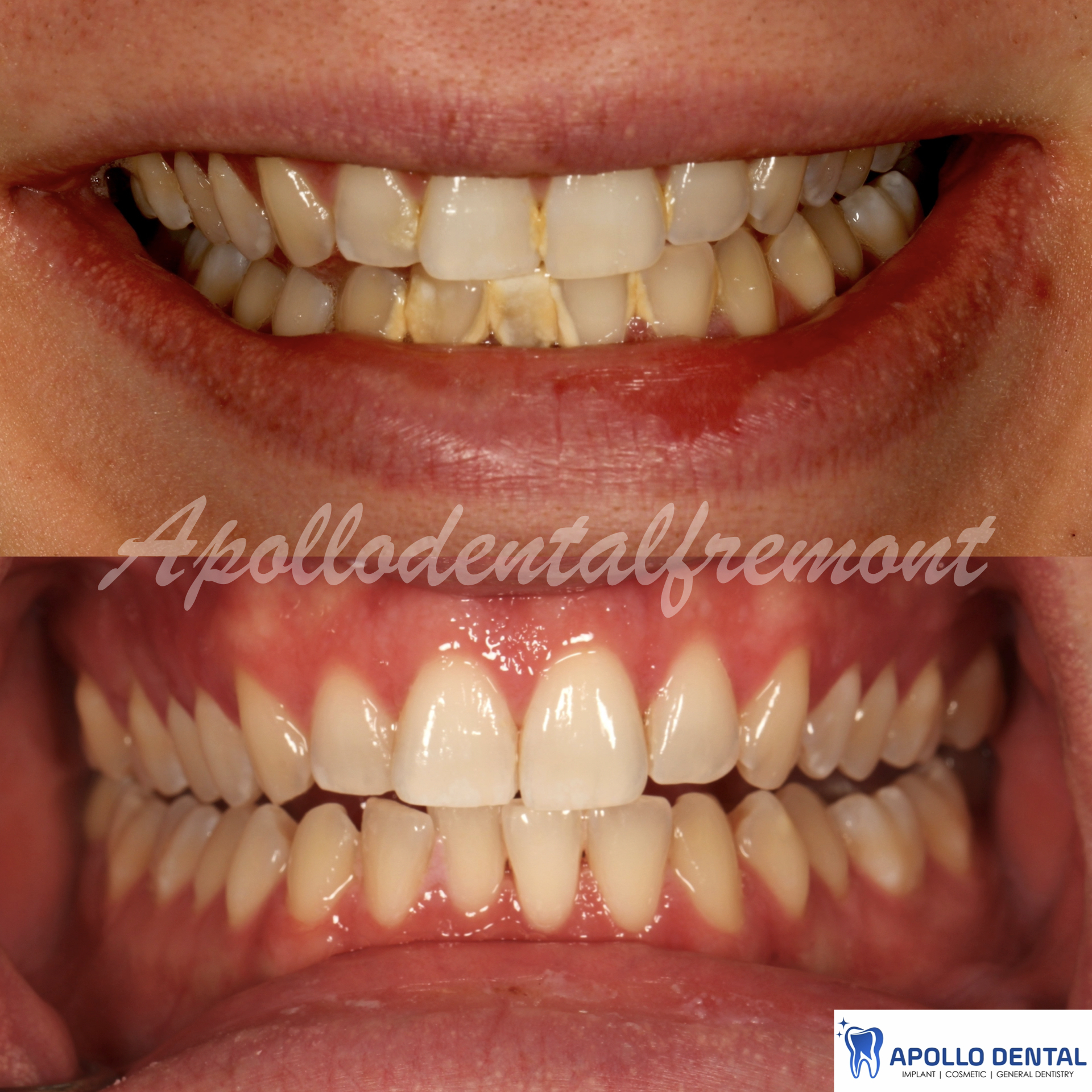 Deep cleaning patient 1