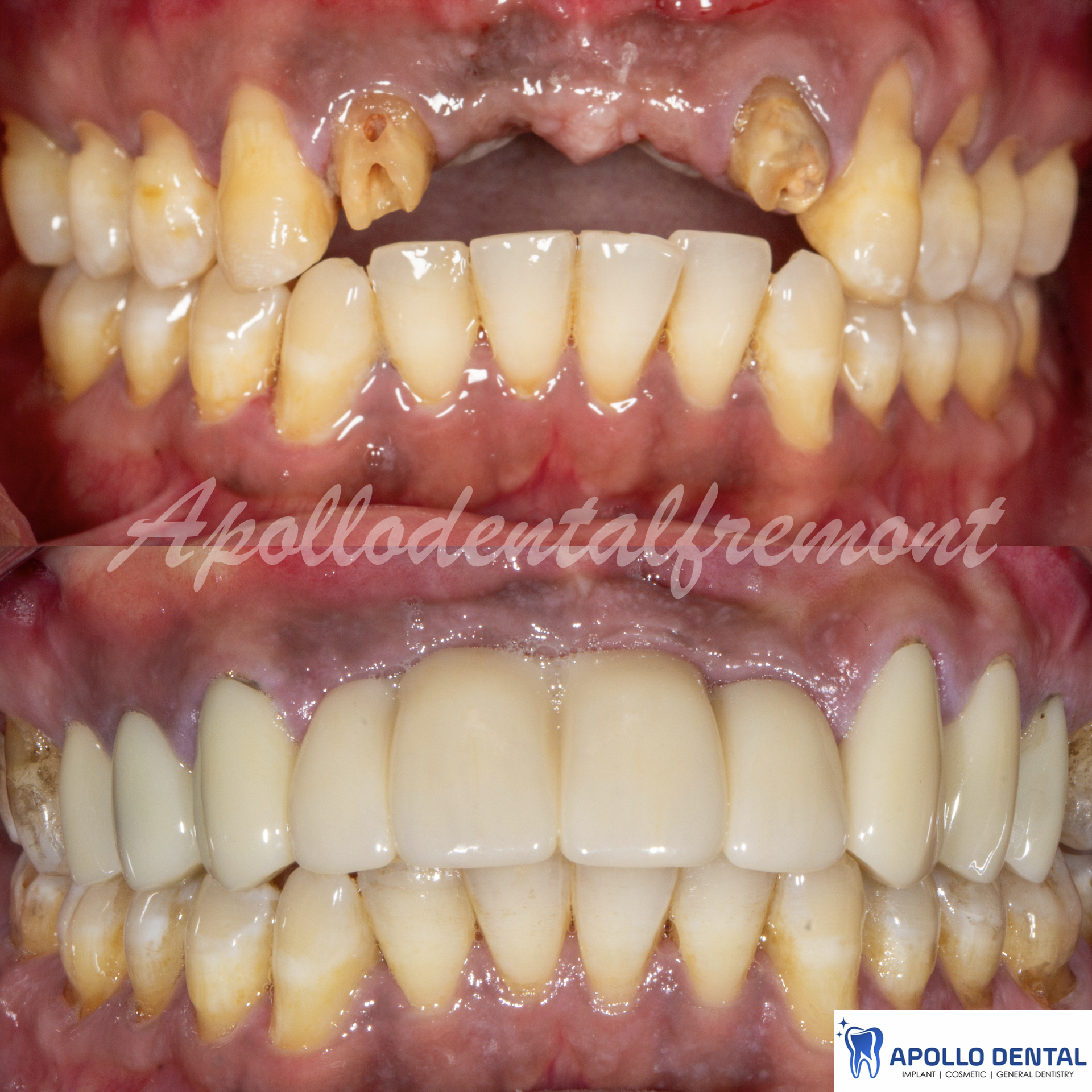 Failed dental bridge replace with implant bridge and veneers