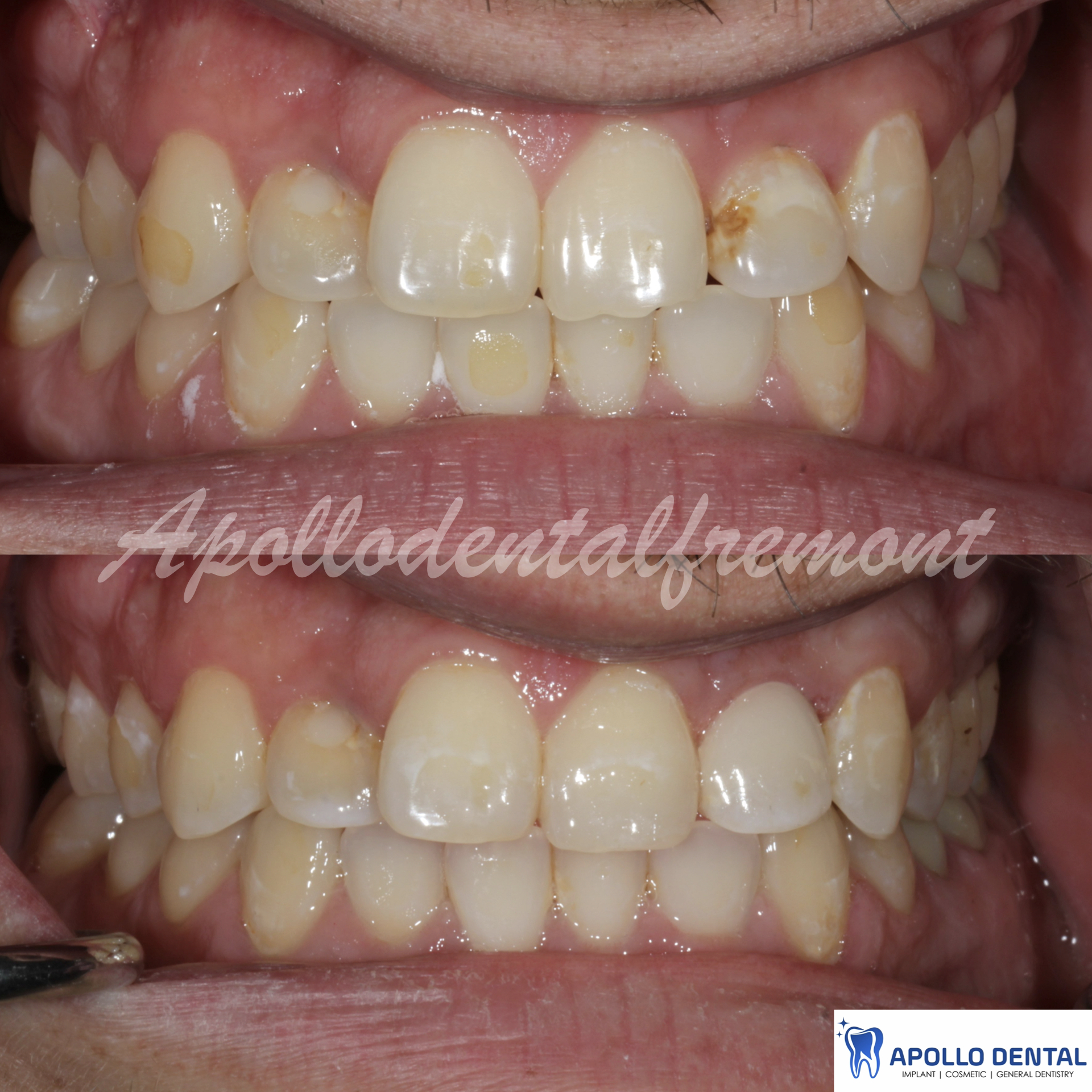 replace tooth fillings