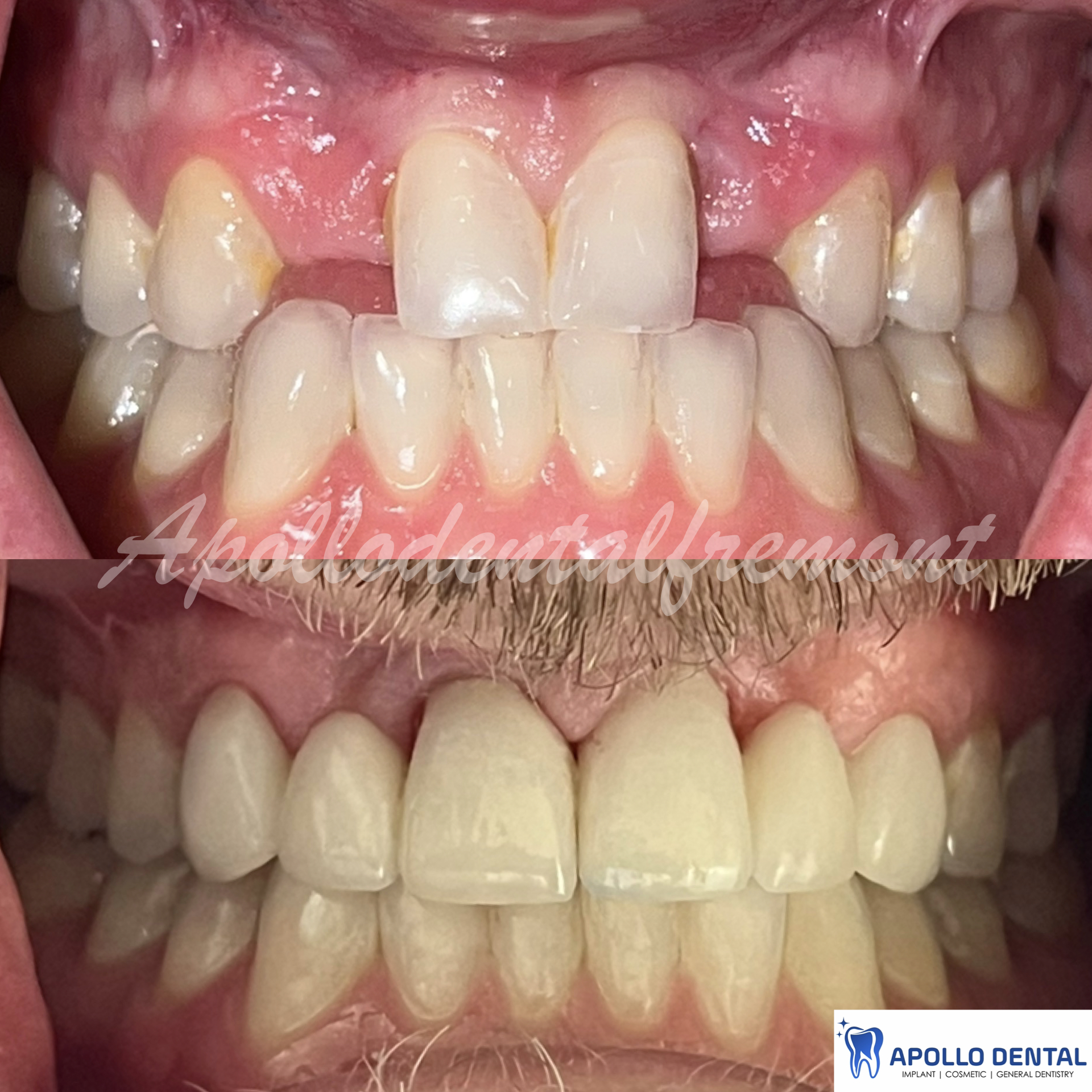 Missing teeth since childhood, patient did not have enough space to place and restore with implants. Dental bridges were used to restore the teeth