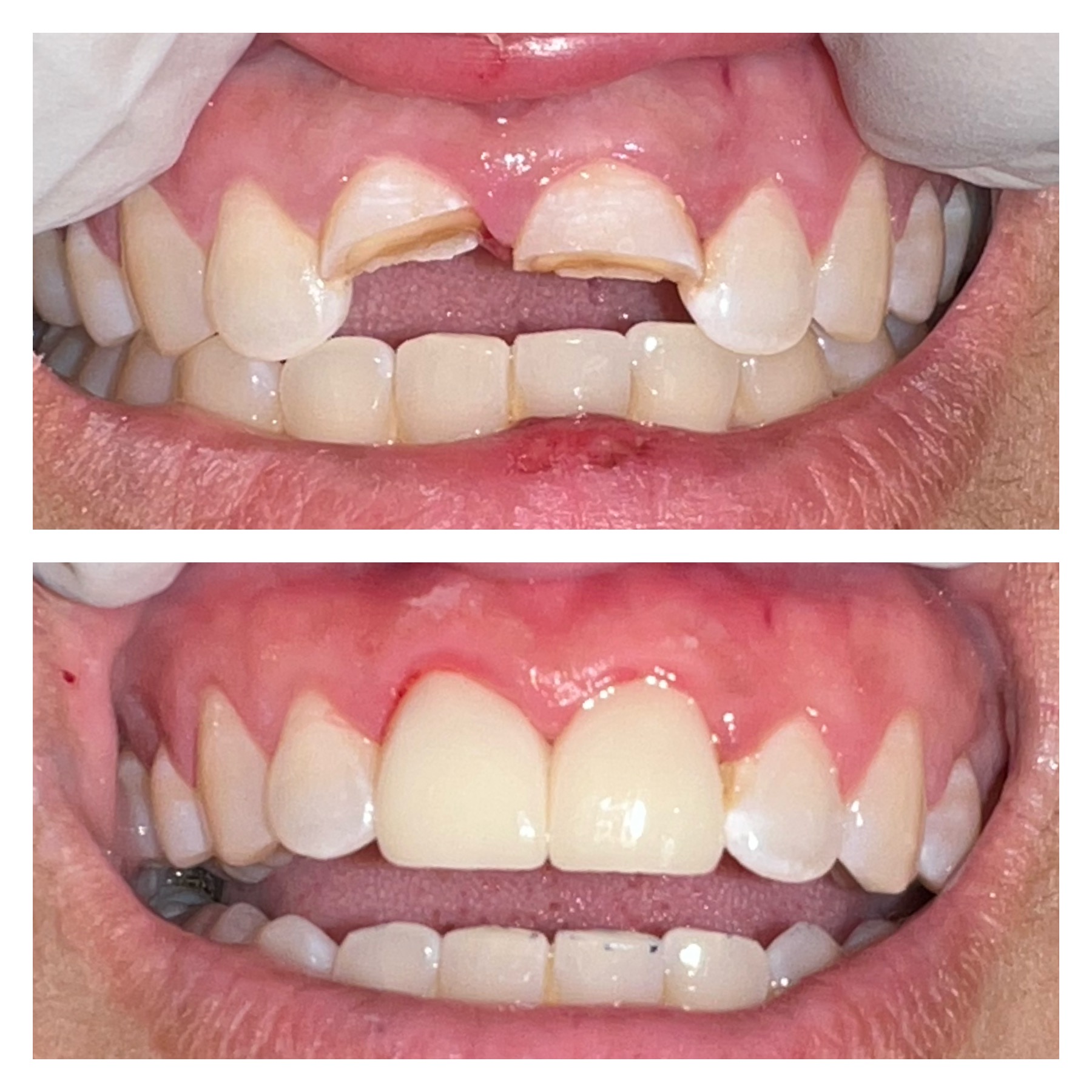 Mom of 4 y_o was hit on the face with a toy, fixed with root canal and crowns