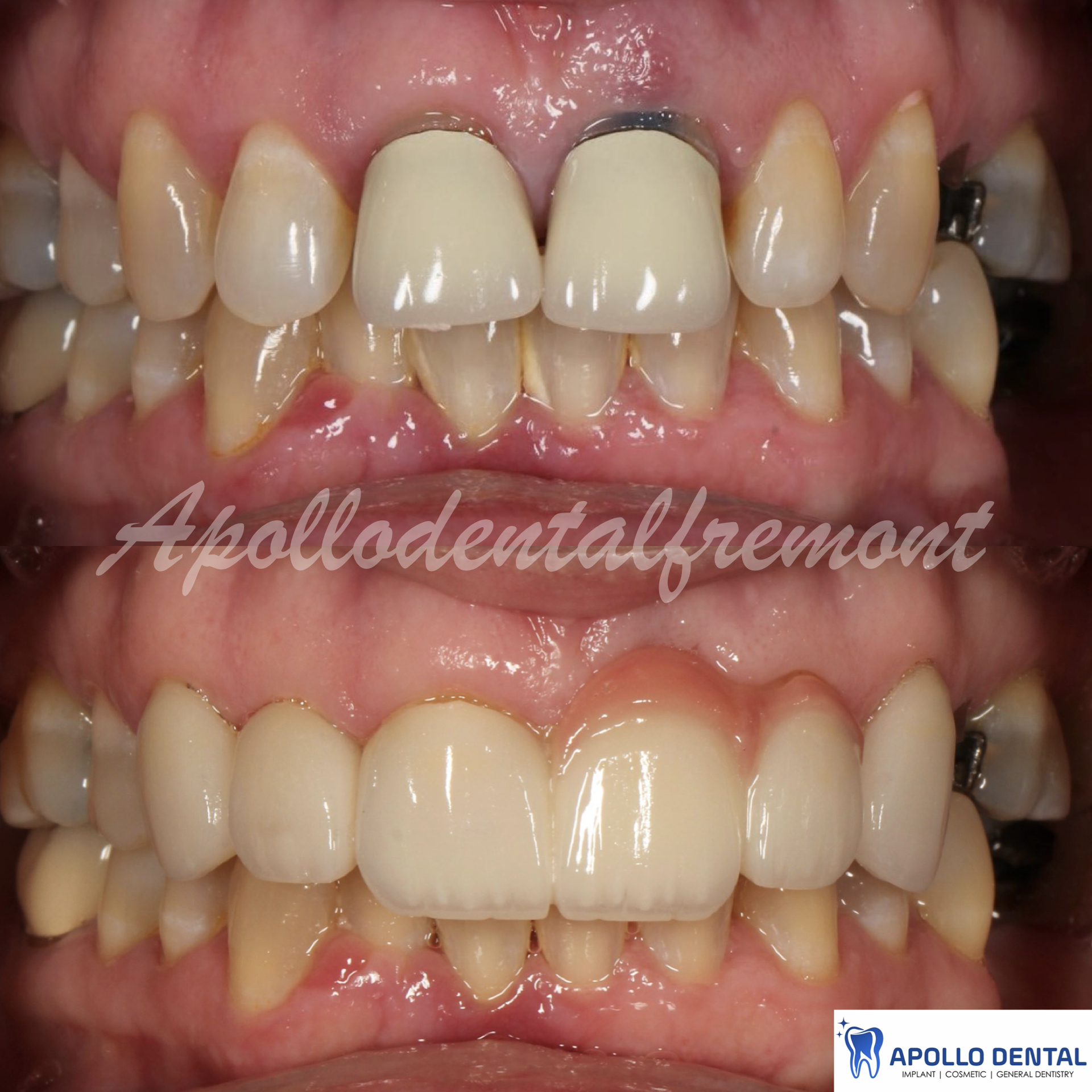 Porcelain added to dental bridge to mimic the natural shape of the teeth and have a good harmony in mouth