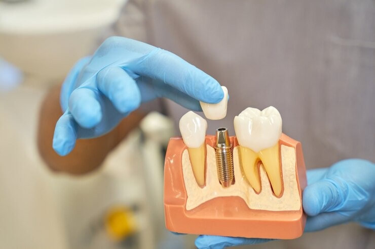 Fremont dentist explaining All-on-4 implant supported denture model during full arch dental implant consultation